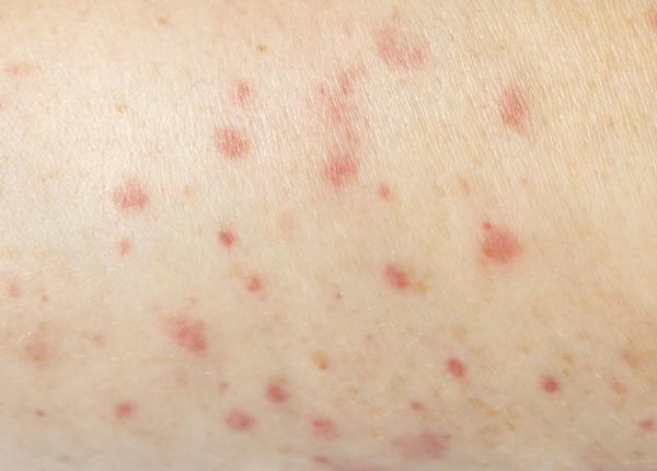 care sunt simptomele rujeolei si cat timp dureaza vaccinul diferenta dintre rujeola si varicela expertii raspund la 6 intrebari cheie care sunt simptomele rujeolei si cat timp dureaza vaccinul diferenta dintre rujeola si varicela expertii raspund la 6 intrebari cheie