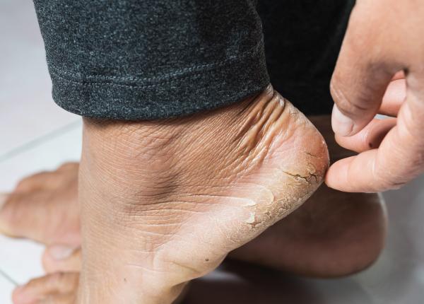 de ce iti crapa calcaiele greseala asta iti distruge talpile crema banala pe care trebuie sa o folosesti de ce iti crapa calcaiele greseala asta iti distruge talpile crema banala pe care trebuie sa o folosesti