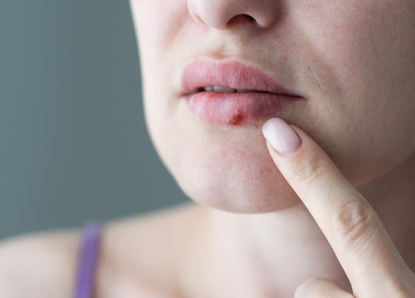ai avut vreodata herpes trebuie sa afli asta semnul banal ca faci alzheimer ai avut vreodata herpes trebuie sa afli asta semnul banal ca faci alzheimer