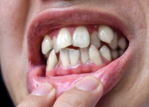 cum pozitia dintilor iti poate schimba postura corpului si reduce durerile de spate