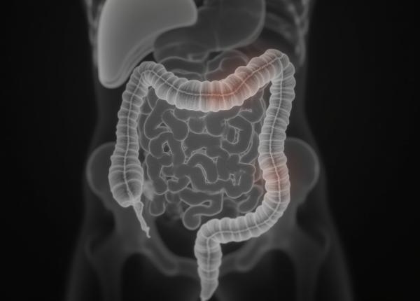 ai dureri de burta poate ai pungi in colon sau diverticuloza afla daca suferi de boala asta ai dureri de burta poate ai pungi in colon sau diverticuloza afla daca suferi de boala asta