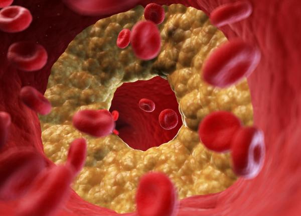 boala arteriala periferica semnal de alarma pentru inima si creier boala arteriala periferica semnal de alarma pentru inima si creier