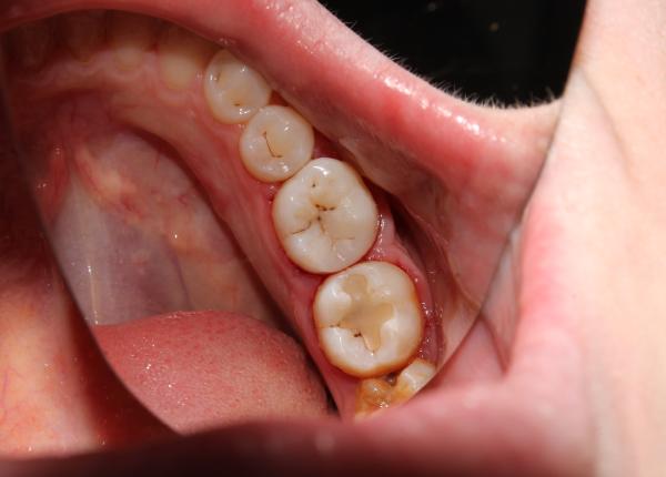 4 alimente si bauturi care macina dintii de ce trebuie sa bei apa dupa ce le consumi 4 alimente si bauturi care macina dintii de ce trebuie sa bei apa dupa ce le consumi