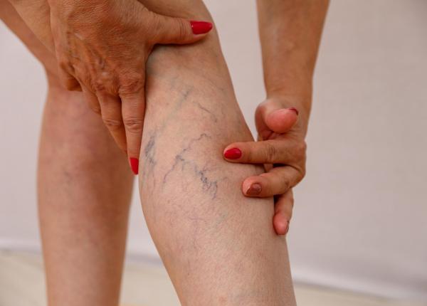 planta care te scapa de varice greseala pe care nu o vei mai face niciodata asa dispar varicele