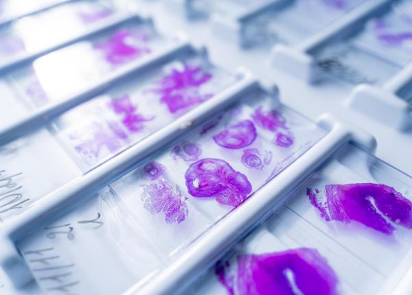 o combinatie de teste genetice ar putea spune care cancer va recidiva si care nu o combinatie de teste genetice ar putea spune care cancer va recidiva si care nu