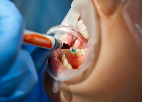 otrava pe care o avem in corp din cauza dintilor amalia nastase am urme de acum 40 de ani otrava pe care o avem in corp din cauza dintilor amalia nastase am urme de acum 40 de ani