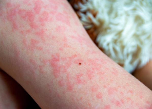 canada isi pierde statutul de tara libera de rujeola dupa trei decenii