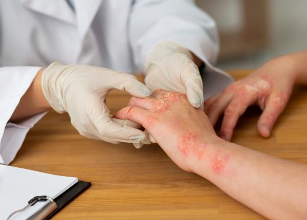 care e diferenta dintre dermatita si eczema