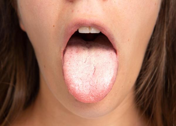 ce sa faci daca ti ai ars limba 9 metode simple pentru limba arsa