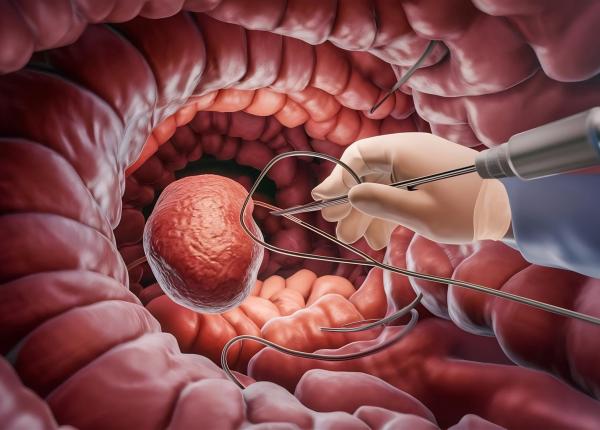 pastila care ar putea elimina colonoscopia