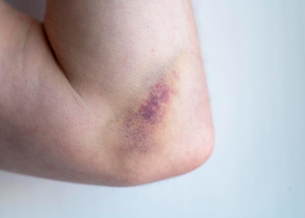 in cat timp se vindeca o vanataie si cum o tratezi corect