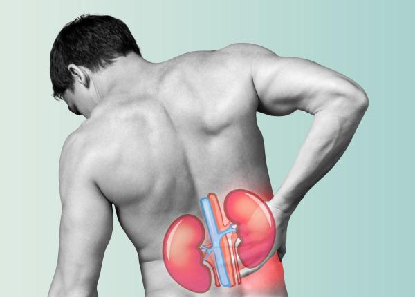 pietre la rinichi simptomele celor 4 etape de la formare la eliminare