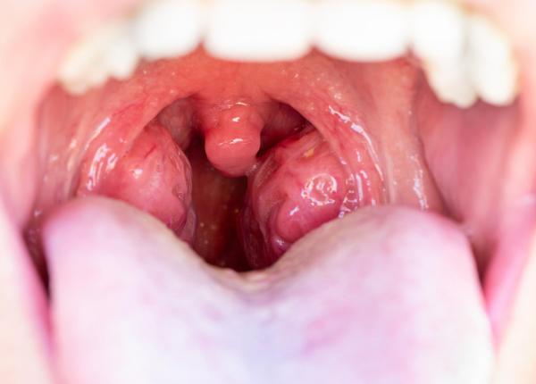 amigdalita semne care o dau de gol