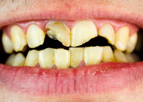 romania codasa la finantarea stomatologiei arata ocde avertismentul cmsr 66 dintre copii si 64 dintre adulti au carii