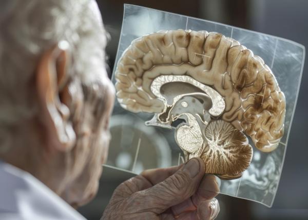 metoda care dezvaluie ce se intampla in creierul pacientilor cu parkinson