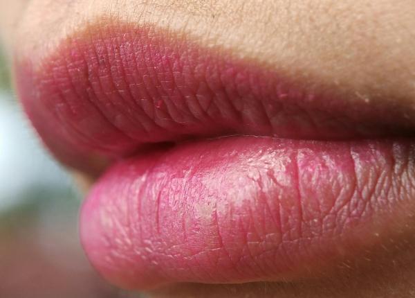 buze crapate ce vitamina iti lipseste din organism