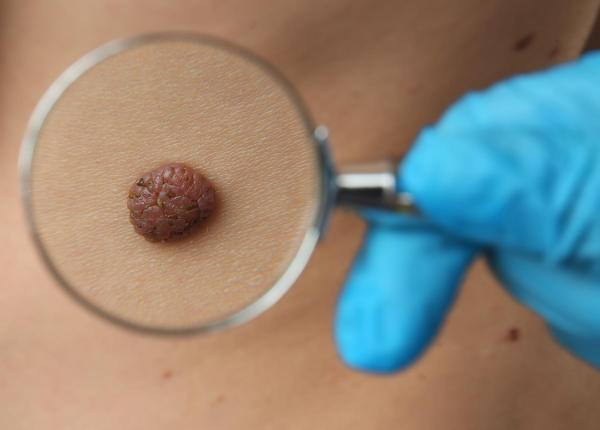 trucul secret prin care cel mai agresiv cancer de piele pacaleste sistemul imunitar