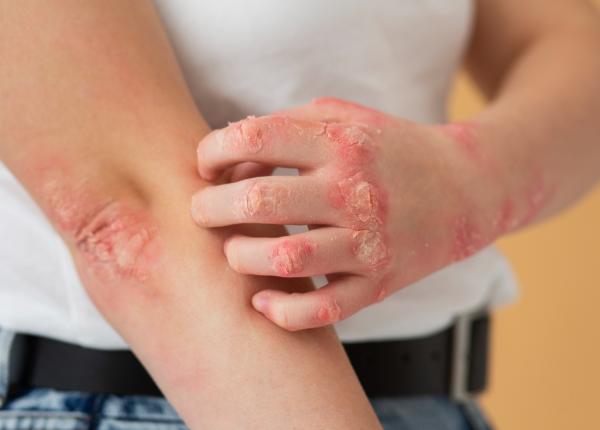 scabie raie ce este si cum se transmite simptomele incep in 4 6 saptamani