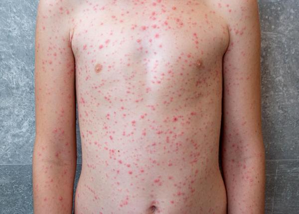 marea britanie si a pierdut statutul de tara libera de rujeola