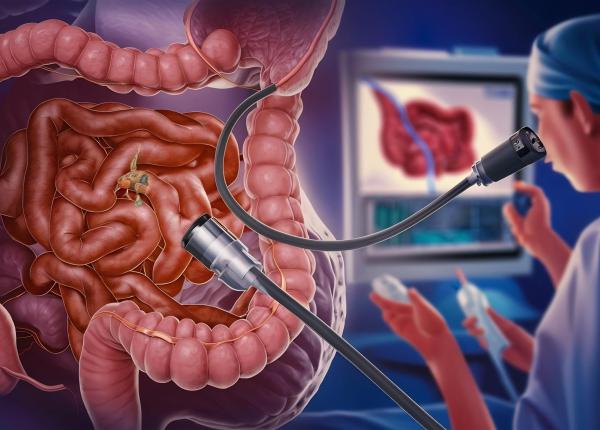 endoscopia tratament eficient pentru reflux gastroesofagian si probleme biliare dr vlad simion sanador arde mucoasa de sub esofag