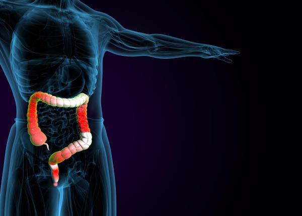 romania aproape de topul ue la cancer colorectal