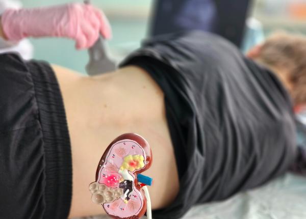 primul semn ca ai pietre la rinichi