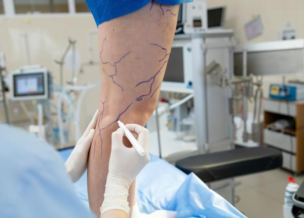 cand e necesara operatia varicelor