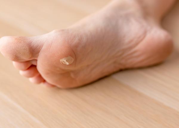 verucile plantare cauze simptome si tratamente care este legatura cu hpv