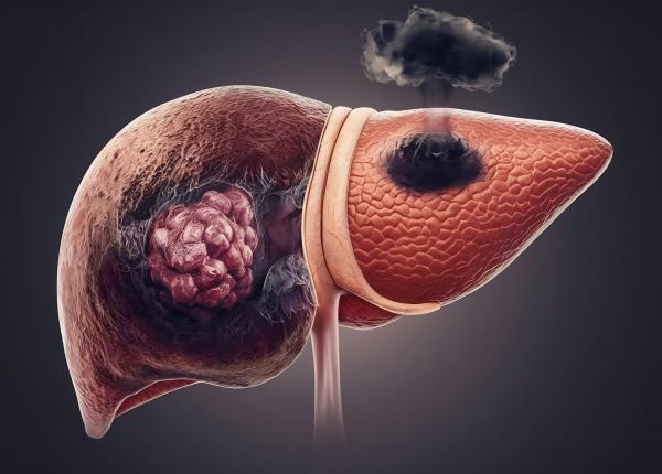 cancerul de ficat prezis cu o acuratete de 93 printr un nou scor de risc