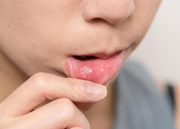 de ce faci herpes la gura