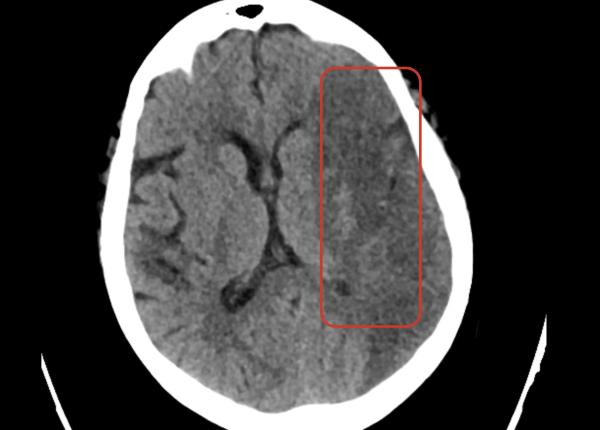 carebot ai head ct cand fiecare secunda salveaza un creier si o viata