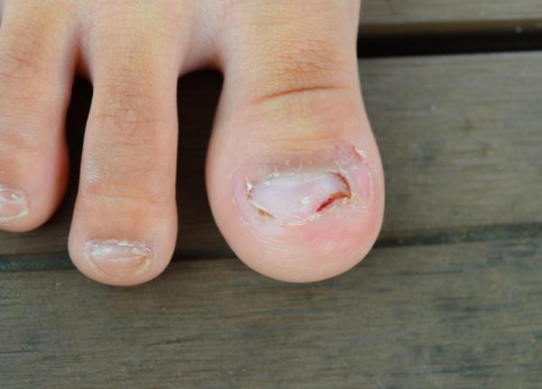 unghiile incarnate de ce apar