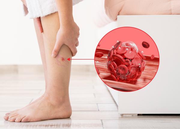 studiu extractul de molid ar putea ajuta in prevenirea trombozei si cheagurilor de sange