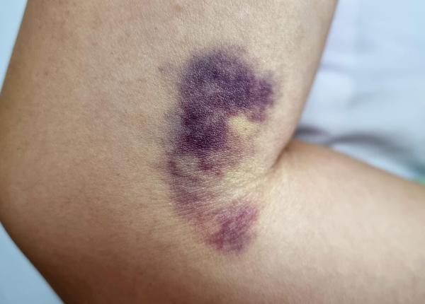 ce inseamna cand o vanataie este verde sau neagra primul semn sa mergi la medic