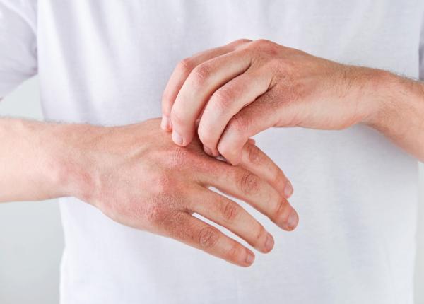 pielea uscata si crapata cum contribuie ureea in sustinerea barierei cutanate