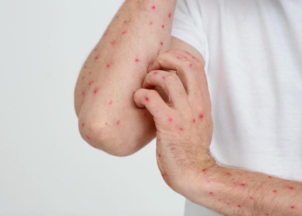 rujeola si scaderea vaccinarii ror in romania riscuri medicale si complicatii severe la copii