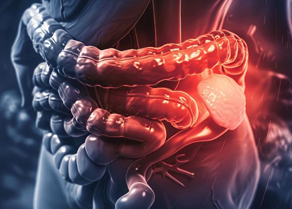 de ce creste alarmant numarul cazurilor de cancer colorectal sub 65 de ani