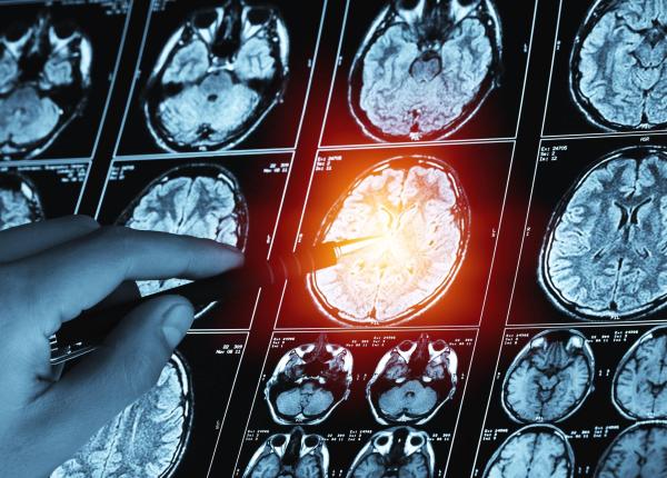 metastazele cerebrale in cancerul de san ce simptome apar si cand apare raspandirea la creier