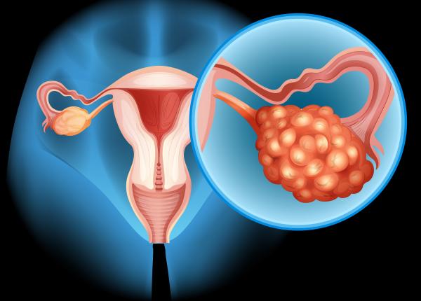 3 din 4 cazuri de cancer ovarian sunt diagnosticate tarziu cand boala e deja avansata fabc avertizeaza