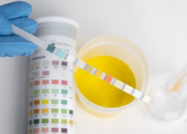 proteine in urina proteinuria ce inseamna si ce afectiuni ascunde acest semn