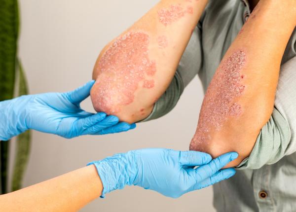 care e diferenta dintre psoriazis si eczema si de ce apar