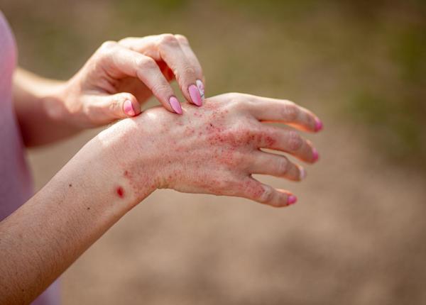 lupus conect program de consiliere psihologica pentru persoanele diagnosticate cu lupus