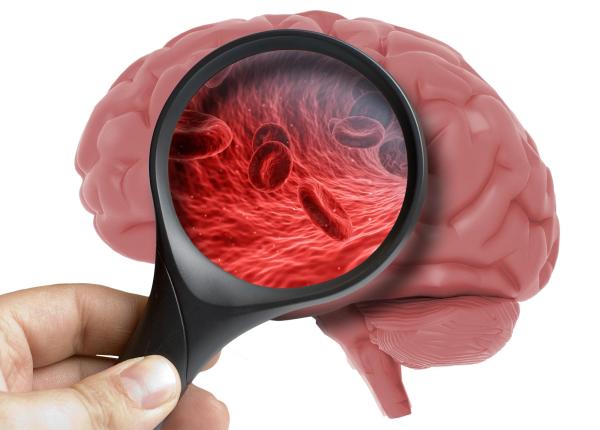 factorul care creste riscul de accident vascular cu 65 chiar si la cei cu colesterol normal