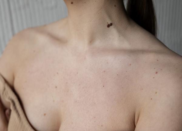 care este diferenta dintre petele solare si cancerul de piele