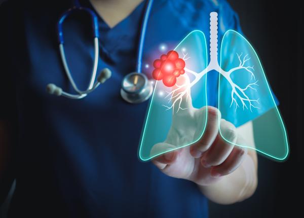 imunoterapia postoperatorie cu nivolumab ineficienta in cancerul pumonar