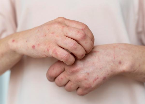 vitamina a folosita gresit impotriva rujeolei a dus la cresteri masive de intoxicatii