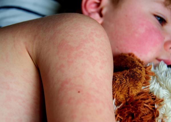 rujeola din nou o amenintare vaccinarea scade iar tratament nu exista