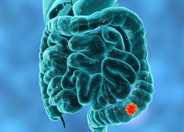 semnele ascunse ale cancerului colorectal pe care tinerii le trec cu vederea