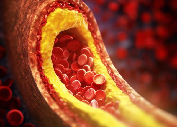 semnele discrete ale colesterolului ridicat pe care multi le trec cu vederea explicatiile unui cardiolog