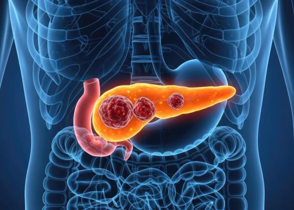 punctul slab al cancerului pancreatic identificat de medici